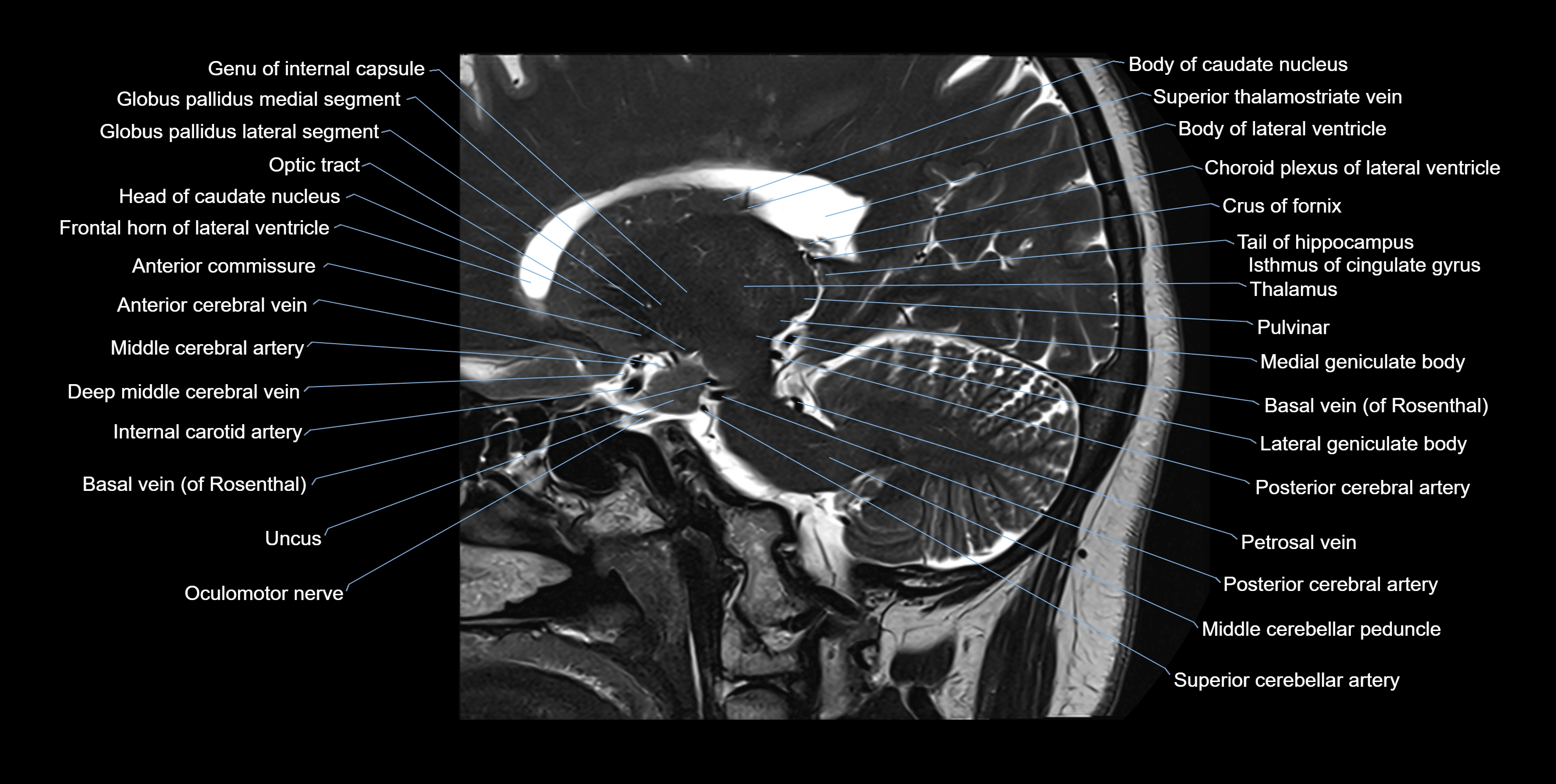 hippocampus sagittal cross sectional anatomy 3T MRI images -img-100011.webp